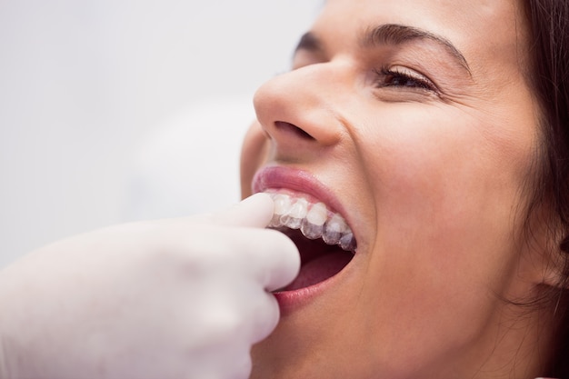 dentist-assisting-female-patient-wear-braces_107420-65490
