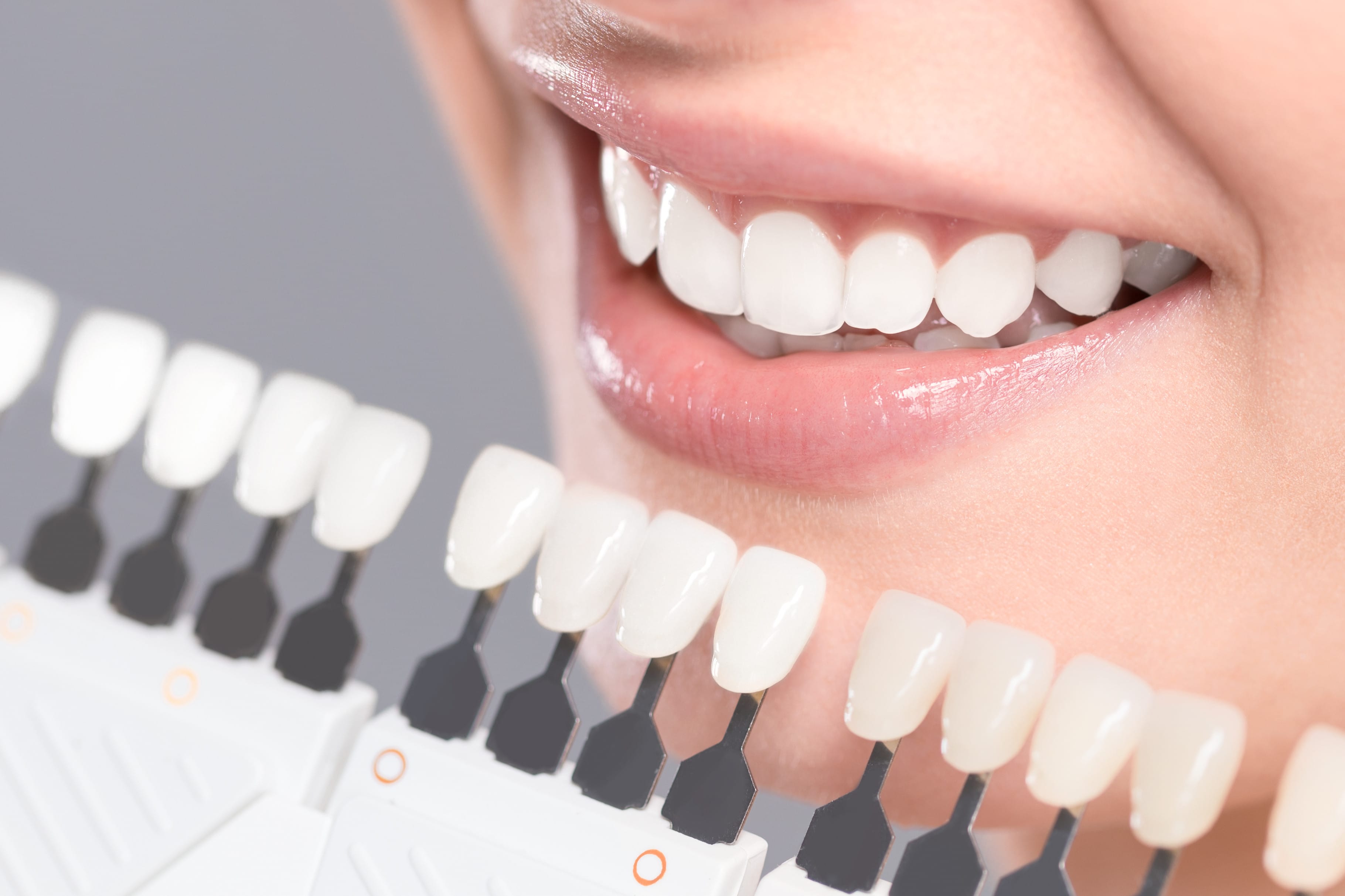 che cosa sono le faccette dentali
